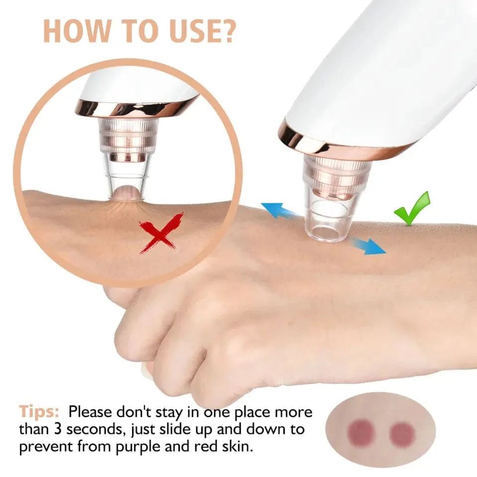 Beautique™Acne Pore & Blackhead Remover Rechargeable